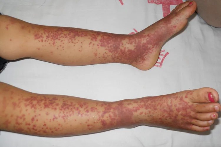 儿童过敏性紫癜图片