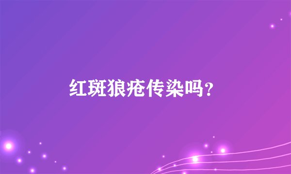 红斑狼疮传染吗？