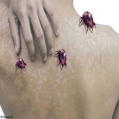 尘螨过敏怎么办  尘螨过敏的3大处理方法揭晓