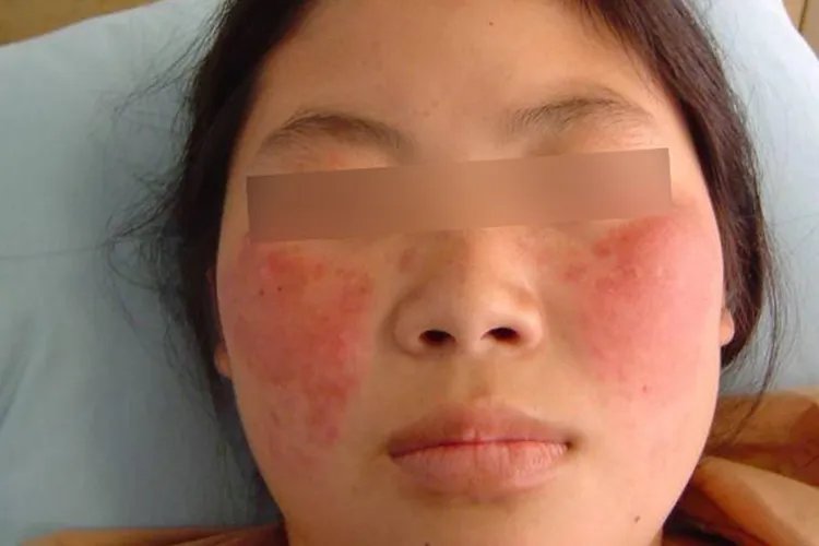 孕妇红斑狼疮图片