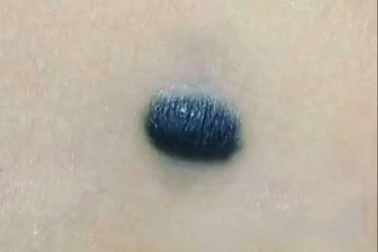 可能癌变的痣图片