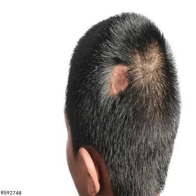 斑秃是什么原因引起的