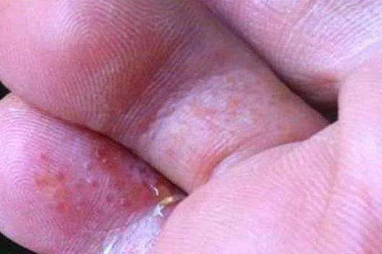 脚癣图片怎么治疗