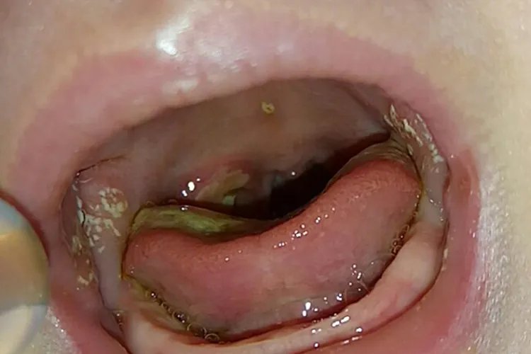 婴儿鹅口疮最早期图片