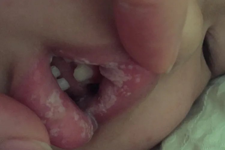 婴儿鹅口疮最早期图片