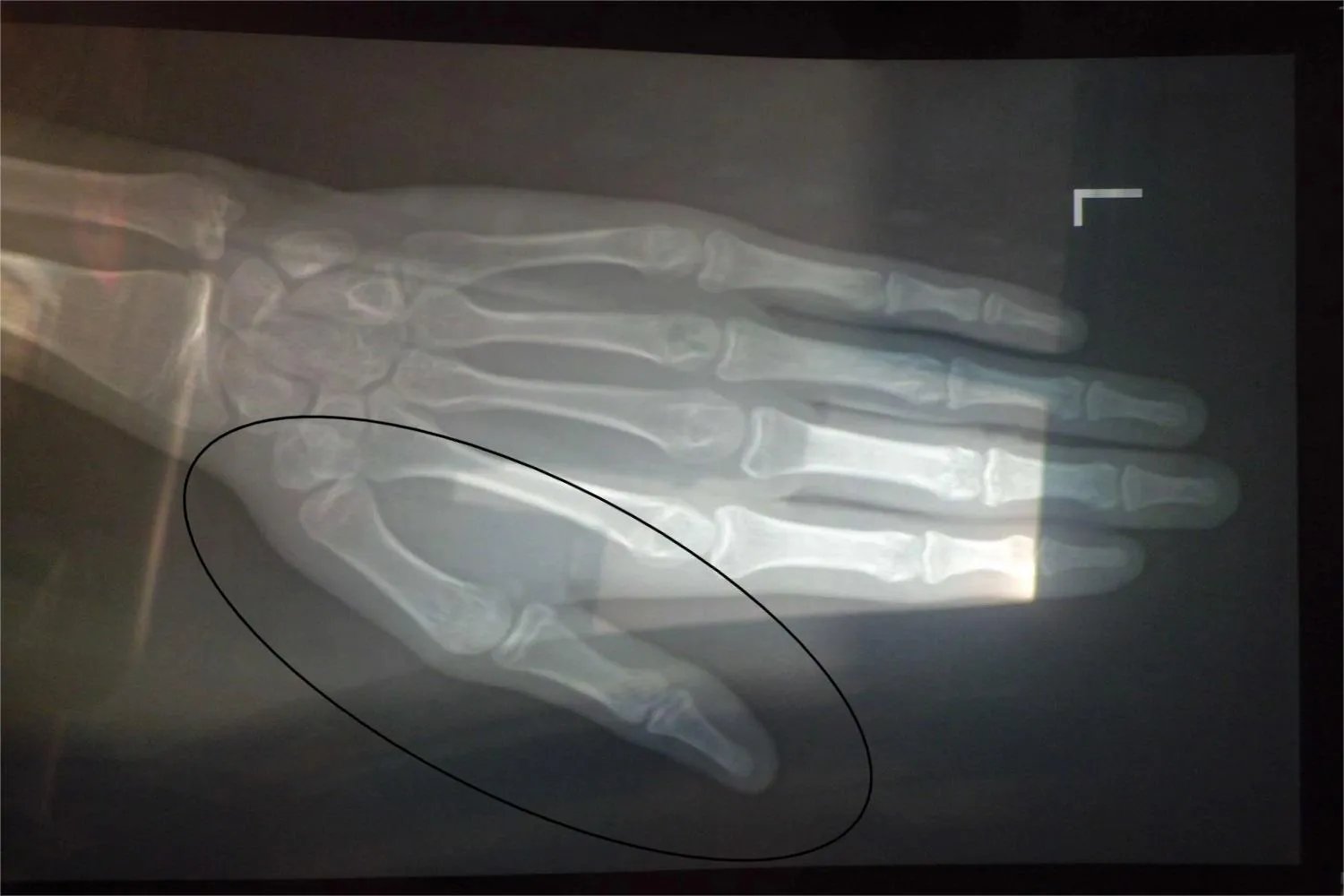 大拇指骨头图片大全