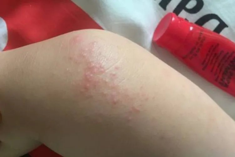 孩子10岁身上起红疙瘩很痒图片