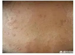 如何判断是不是得了扁平疣？