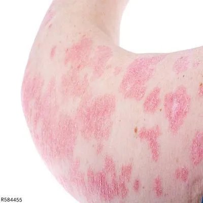 布特软膏可以治银屑病吗 这四种药膏治银屑病常用