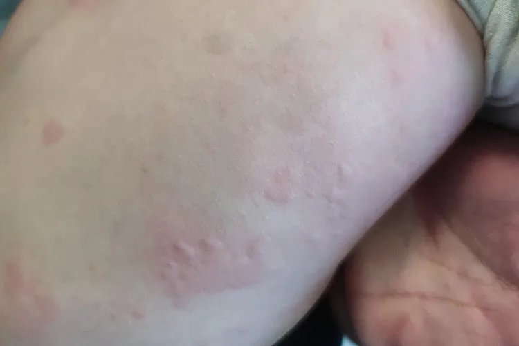 孩子10岁身上起红疙瘩很痒图片