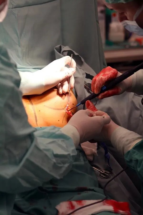 丰胸手术怎么做