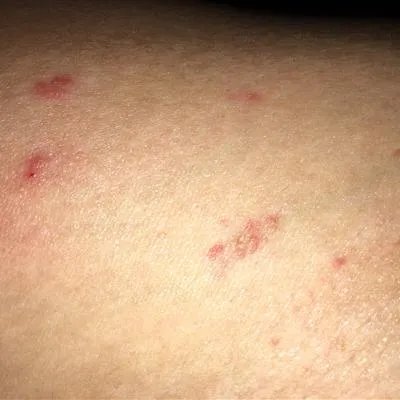 药物性皮炎怎么办?