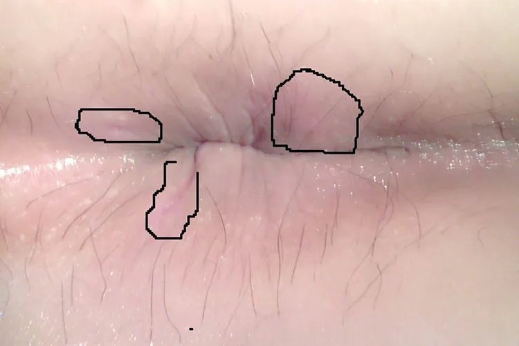 肛瘘早期什么样子图片大全