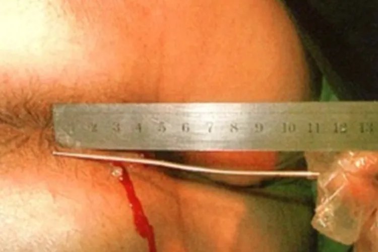 肛瘘早期什么样子图片大全