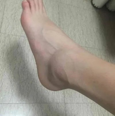 骨裂的症状主要表现为什么？