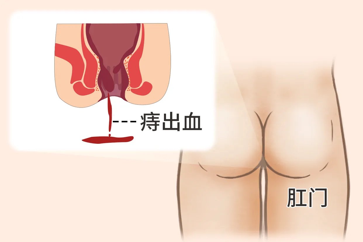 痔疮出血图片