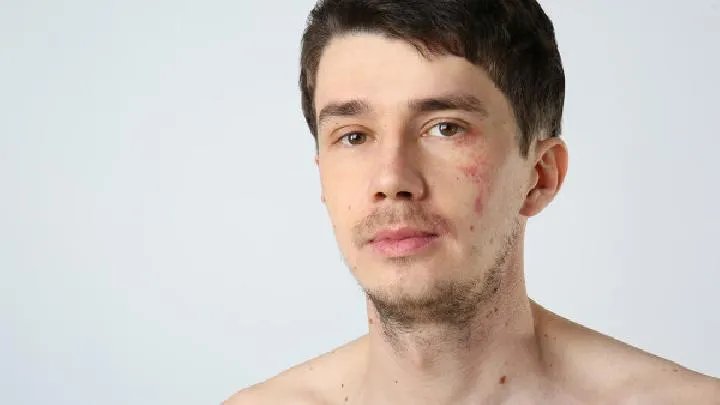 咖啡斑的检查项目有哪些