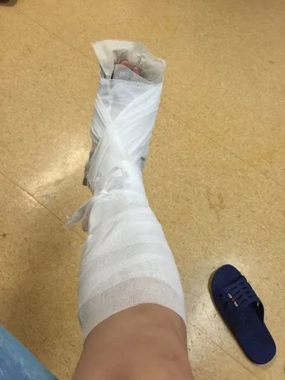 骨裂的症状主要表现为什么？