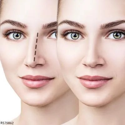 硅胶隆鼻注意事项 硅胶隆鼻的前后注意事项盘点