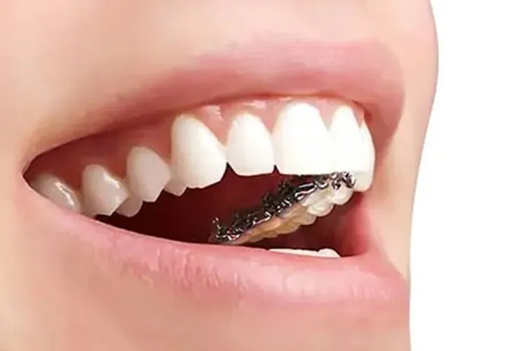 各种牙套的样子图片