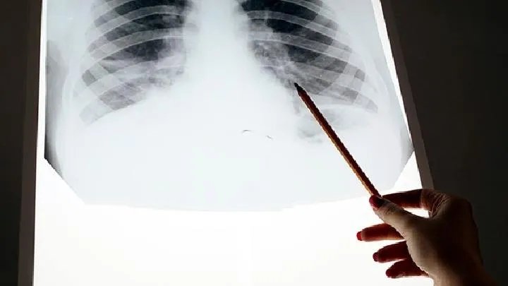 血管瘤是怎么回事