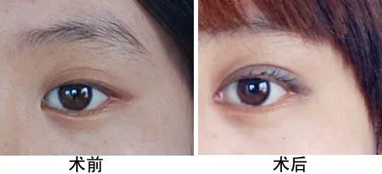 九院开眼角多少钱