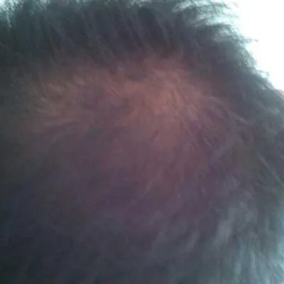 男人30岁脱发怎么回事?