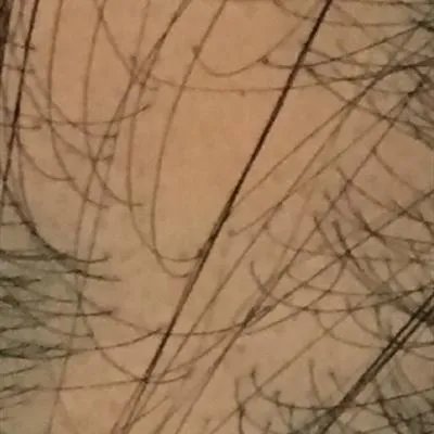 男人30岁脱发怎么回事?