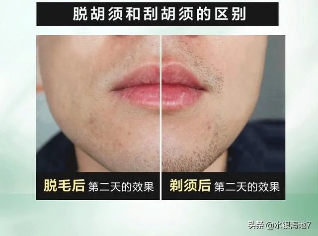 你们知道男人胡子脱毛价格优惠的产品吗？给我推荐下吧？