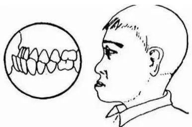 骨性地包天脸型图