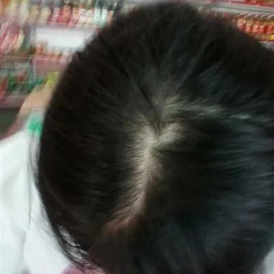 男人30岁脱发怎么回事?